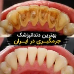 بهترین دکتر جرم‌گیری دندان در ایران - هزینه و روش‌ها