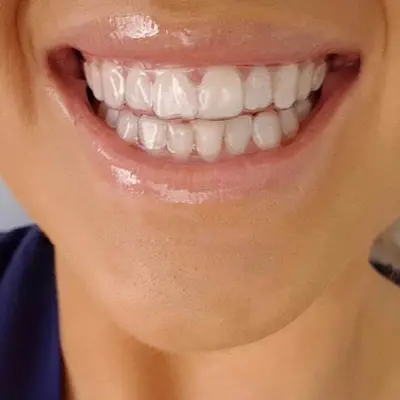 تری بلیچینگ دندان
