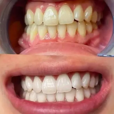 عکس قبل و بعد بلیچینگ آفیس