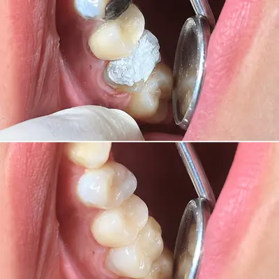 پوسیدگی عمیق و آسیب جدی دندان