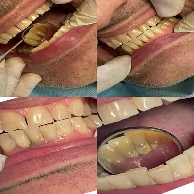 جرم زیر لثه در آینه‌ی دندانپزشکی؛ رسوب قهوه‌ای پشت دندان‌های پایین که در معاینه دیده می‌شود