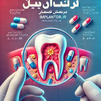 بهترین آنتی بیوتیک برای عفونت دندان عقل + درمان سریع