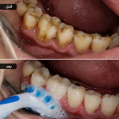 قبل و بعد از برداشتن جرم دندان‌های پایین
