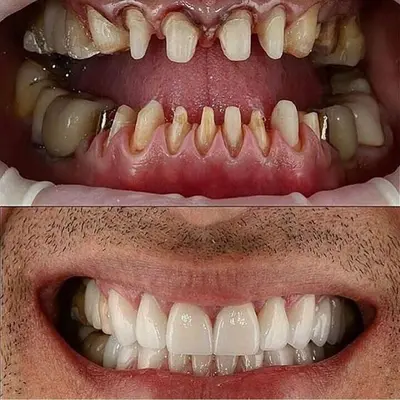 زیباسازی لبخند با روکش دندان جلو