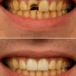 قیمت روکش دندان 1404