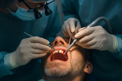 عکس لحظه جراحی ایمپلنت کره‌ای با ابزار تخصصی