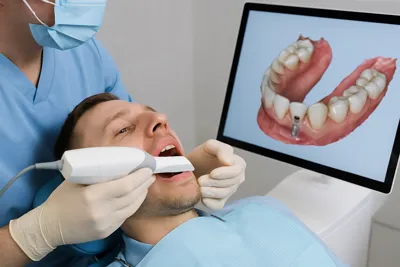 ایمپلنت دیجیتال بهتره یا معمولی؟