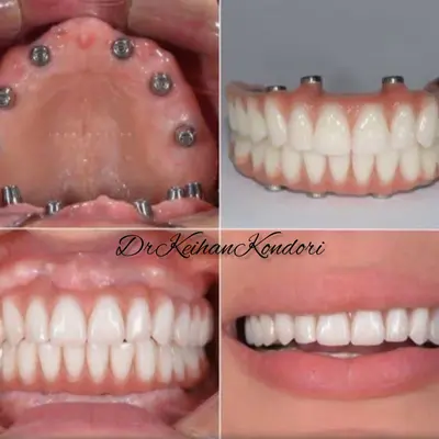 سطح داخلی پروتز اوردنچر و محل قطعات نگهدارنده