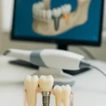 عمر ایمپلنت دیجیتال