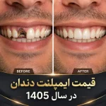 قیمت ایمپلنت دندان در سال ۱۴۰۵