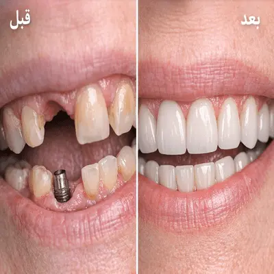 قیمت ایمپلنت تهران