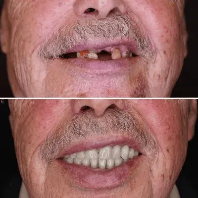 اصلاح لبخند با جایگزینی دندان از دست‌رفته