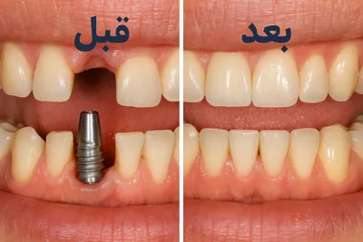 هزینه ایمپلنت دندان با بیمه