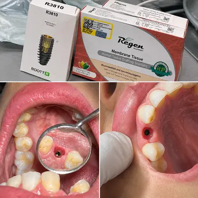 جراحی کاشت ایمپلنت دندان و آماده سازی محل ایمپلنت توسط دندانپزشک متخصص