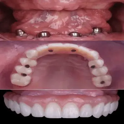 پروتز کامل فک بالا با پایه‌های کاشت متصل