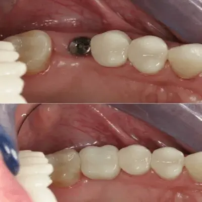 قرارگیری پایه و روکش در ناحیه دندان‌های عقب