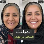 ایمپلنت اقساطی تهران