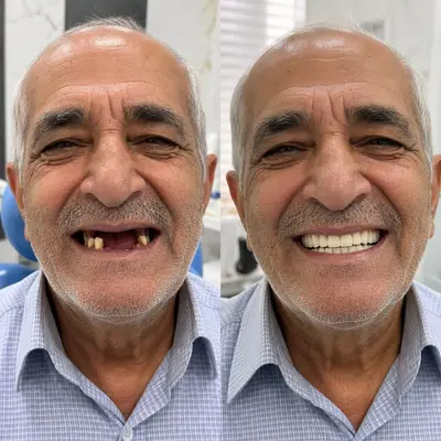اقساط ایمپلنت کامل فک