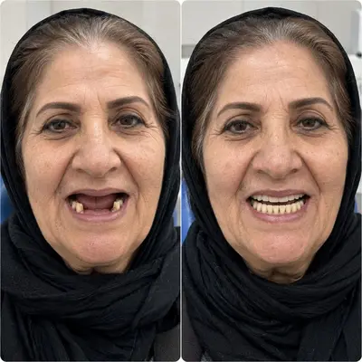 ایمپلنت اقساطی بدون چک