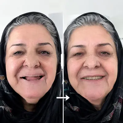 ایمپلنت قسطی بدون پیشپرداخت