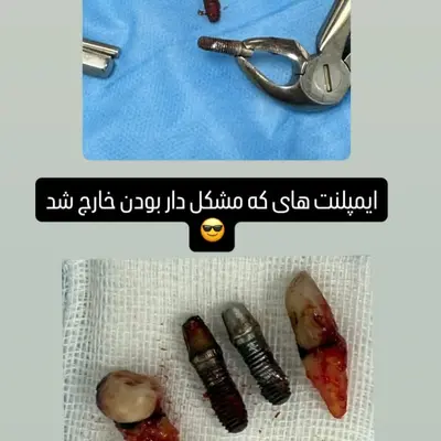 ایمپلنت‌های مشکل‌دار خارج‌شده در کنار دندان‌های کشیده‌شده