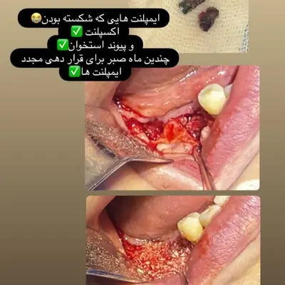 خارج کردن ایمپلنت شکسته و پیوند استخوان برای کاشت مجدد
