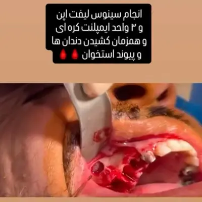 سینوس لیفت با پیوند استخوان و کاشت همزمان ۳ ایمپلنت