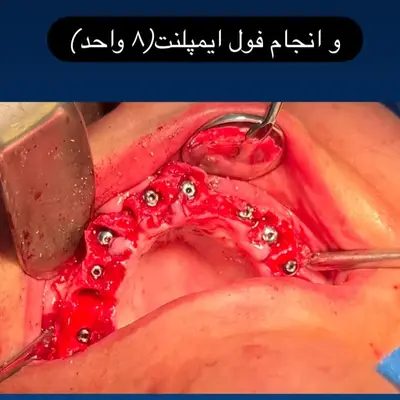 ایمپلنت دندان چقدر طول میکشد؟