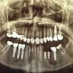 قیمت کاشت دندان طبیعی