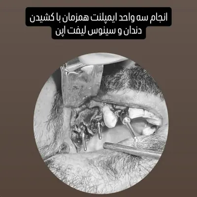 کاشت سه ایمپلنت همزمان با کشیدن دندان و سینوس لیفت
