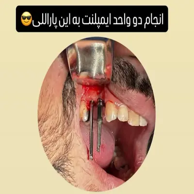 کاشت دو واحد ایمپلنت با پین موازی‌سنج در فک بالا