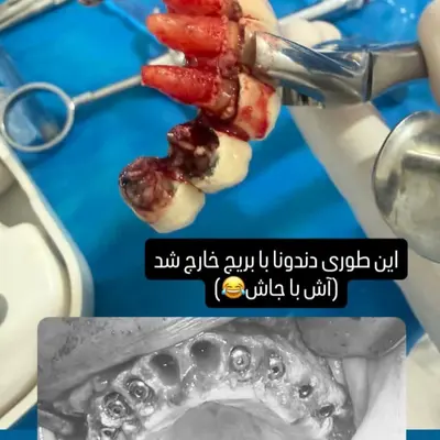 آیا ایمپلنت دندان درد دارد؟