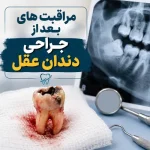 مراقبتهای بعد از جراحی دندان عقل