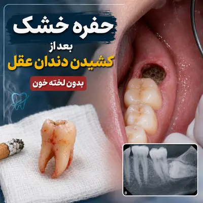 مراقبت های بعد از جراحی دندان عقل