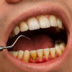 خطرات جرم‌گیری دندان