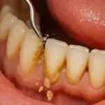 اگر دندان را جرمگیری نکنیم چه میشود؟