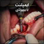 ایمپلنت با بیهوشی