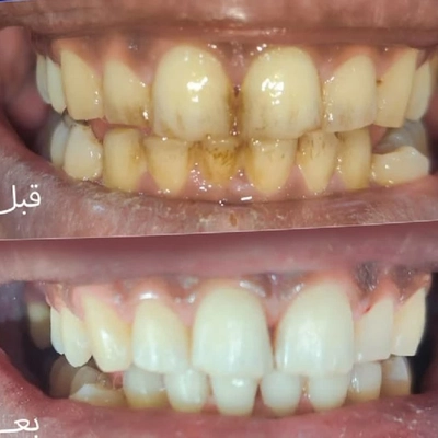 دندانها قبل و بعد از جرمگیری؛ برداشته شدن لکه و جرم