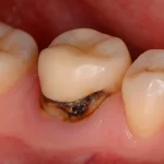 علائم پوسیدگی دندان زیر روکش