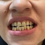 خونریزی بعد از جرم‌گیری دندان