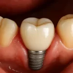 روکش دندان ایمپلنت چقدر طول میکشد؟