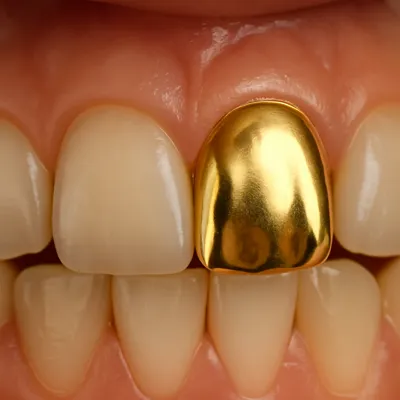 روکش طلای براق روی دندان جلو