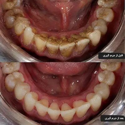 تفاوت جرم‌گیری و بلیچینگ دندان