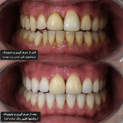 فرق جرم‌گیری لثه با جرم‌گیری دندان