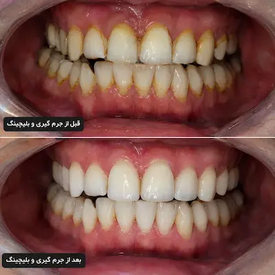 جرم‌گیری بهتر است یا بلیچینگ