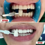 تفاوت جرم‌گیری و بلیچینگ دندان و هزینه هر کدام در ۱۴۰۵