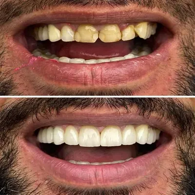 کامپوزیت ونیر دندان ۱۴۰۴