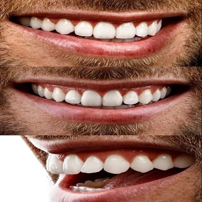 کامپوزیت دندان جلو طبیعی