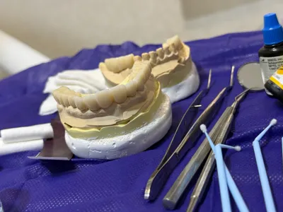 مراحل طراحی بهترین نوع روکش دندان روی قالب گچی
