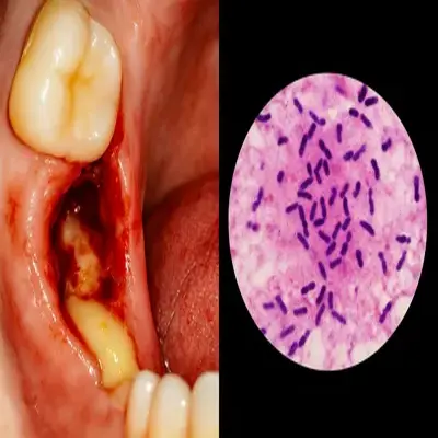 عفونت محل کشیدن دندان با خروج چرک